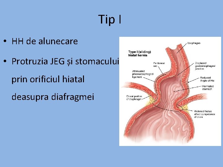 Tip I • HH de alunecare • Protruzia JEG și stomacului prin orificiul hiatal