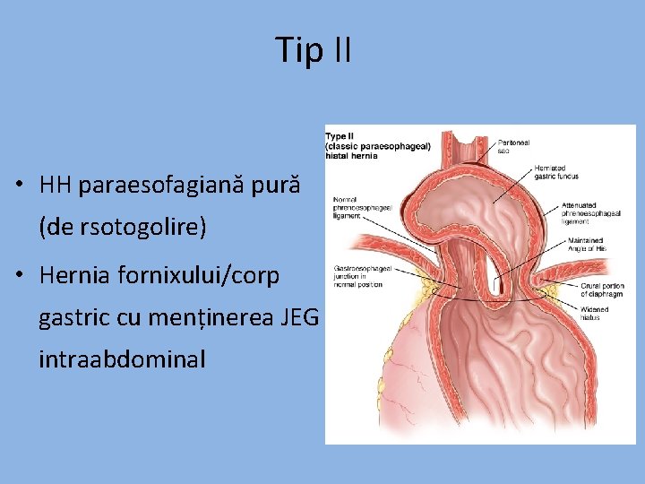 Tip II • HH paraesofagiană pură (de rsotogolire) • Hernia fornixului/corp gastric cu menținerea