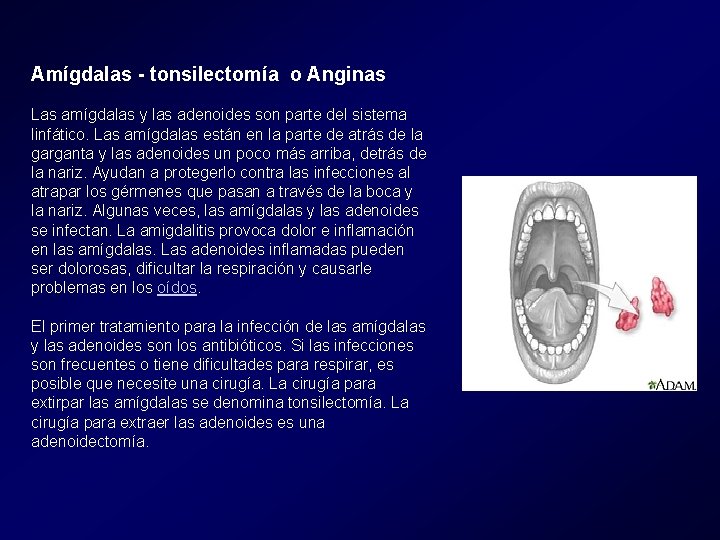 Amígdalas - tonsilectomía o Anginas Las amígdalas y las adenoides son parte del sistema Amígdalas - tonsilectomía o Anginas Las amígdalas y las adenoides son parte del sistema