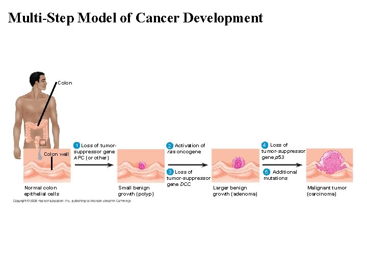 Multi-Step Model of Cancer Development Colon EFFECTS OF MUTATIONS 1 Loss of tumorsuppressor gene