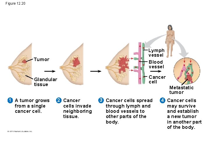 Figure 12. 20 Tumor Lymph vessel Blood vessel Glandular tissue Cancer cell 1 A