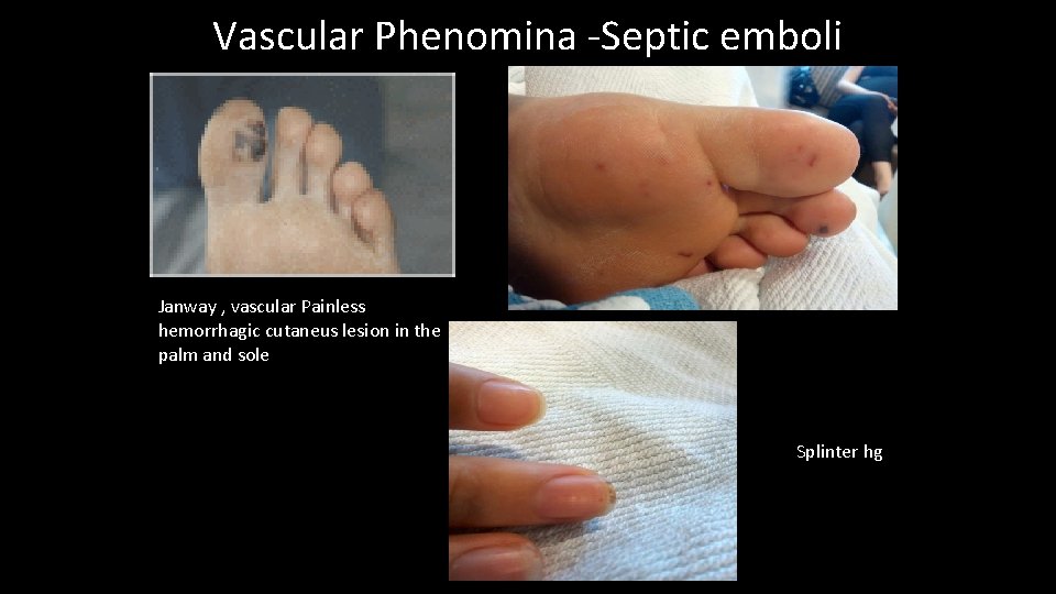 Vascular Phenomina -Septic emboli Janway , vascular Painless hemorrhagic cutaneus lesion in the palm