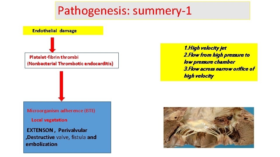 Pathogenesis: summery-1 Endothelial damage Platelet-fibrin thrombi (Nonbacterial Thrombotic endocarditis) Microorganism adherence (BTE) Local vegetation