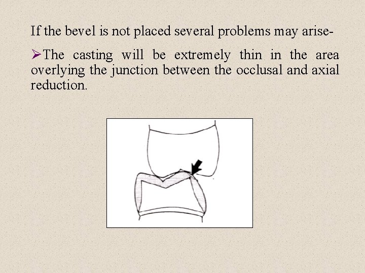 If the bevel is not placed several problems may arise ØThe casting will be