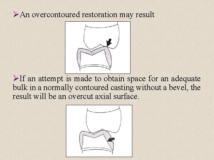 ØAn overcontoured restoration may result ØIf an attempt is made to obtain space for