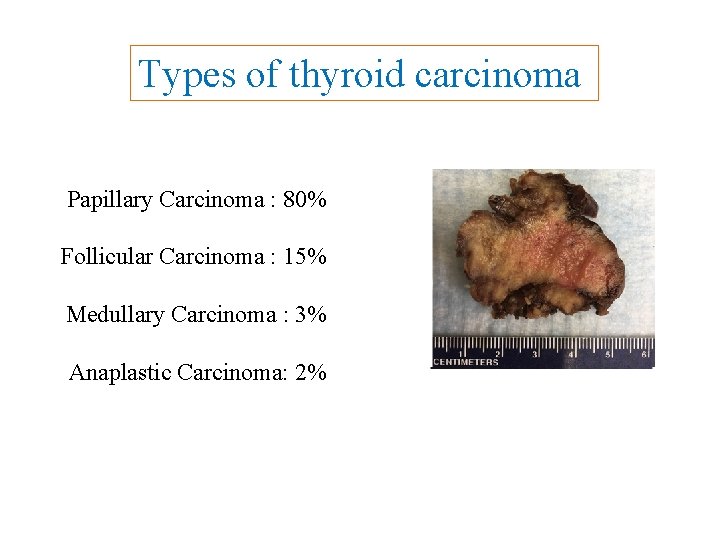 Types of thyroid carcinoma Papillary Carcinoma : 80% Follicular Carcinoma : 15% Medullary Carcinoma