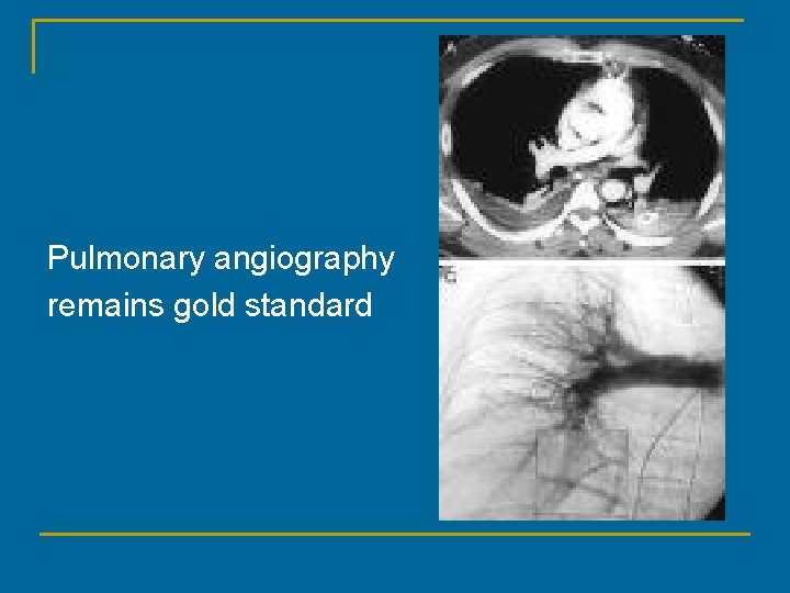 Pulmonary angiography remains gold standard 