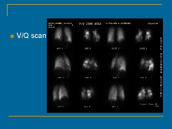 n V/Q scan 