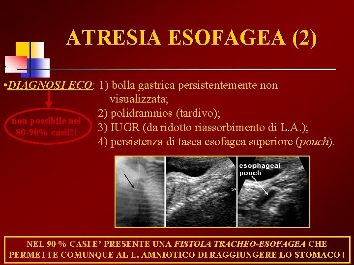 ATRESIA ESOFAGEA (2) • DIAGNOSI ECO: ECO 1) bolla gastrica persistentemente non visualizzata; 2)