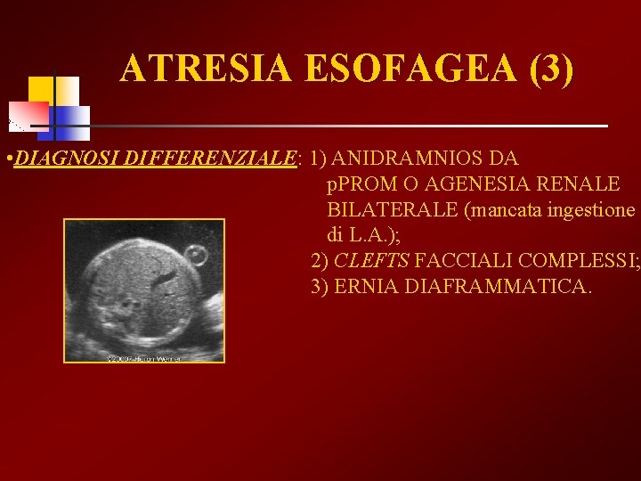 ATRESIA ESOFAGEA (3) • DIAGNOSI DIFFERENZIALE: DIFFERENZIALE 1) ANIDRAMNIOS DA p. PROM O AGENESIA