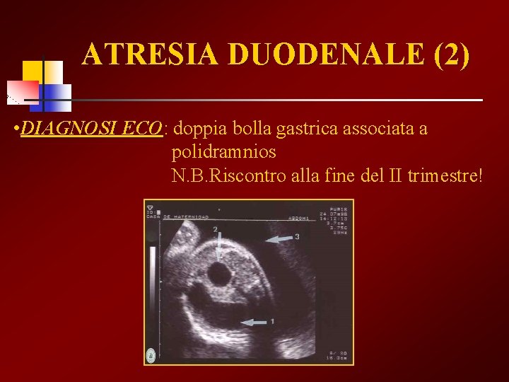 ATRESIA DUODENALE (2) • DIAGNOSI ECO: ECO doppia bolla gastrica associata a polidramnios N.