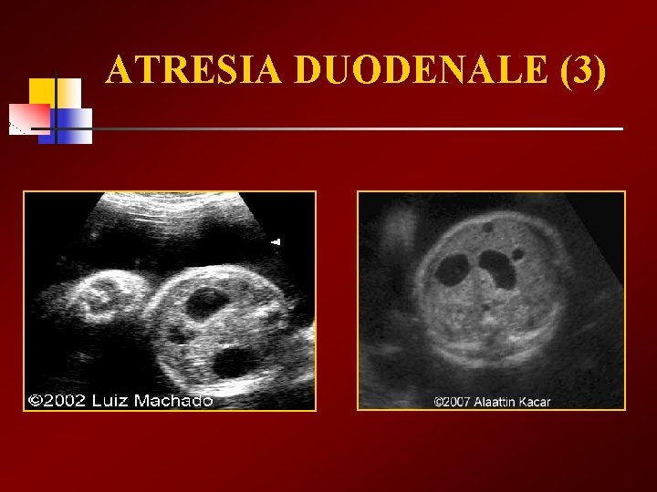 ATRESIA DUODENALE (3) 