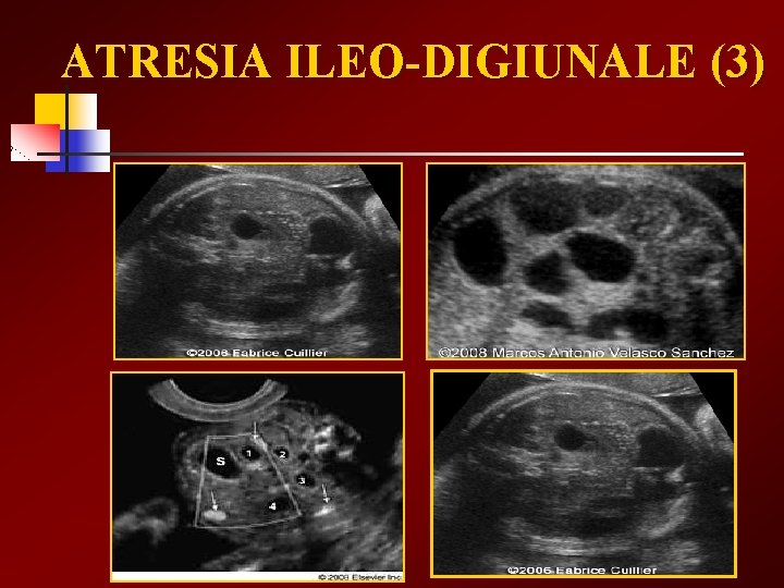 ATRESIA ILEO-DIGIUNALE (3) 