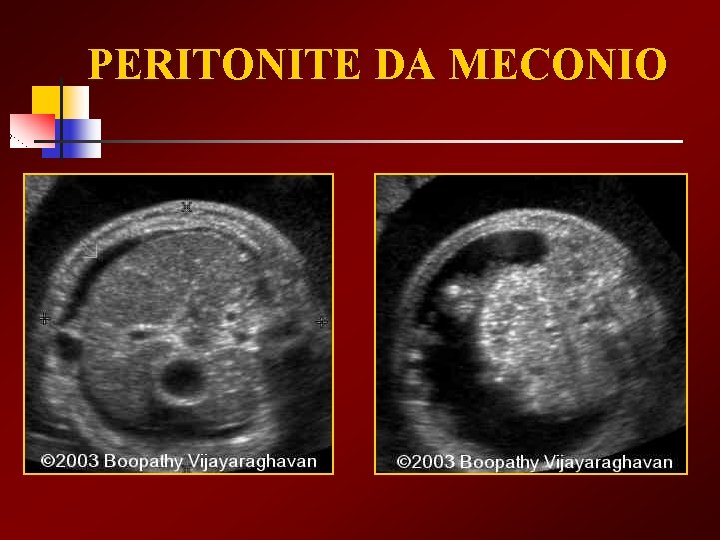 PERITONITE DA MECONIO 