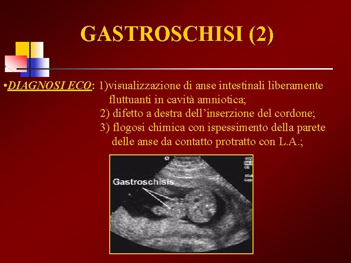 GASTROSCHISI (2) • DIAGNOSI ECO: ECO 1)visualizzazione di anse intestinali liberamente fluttuanti in cavità