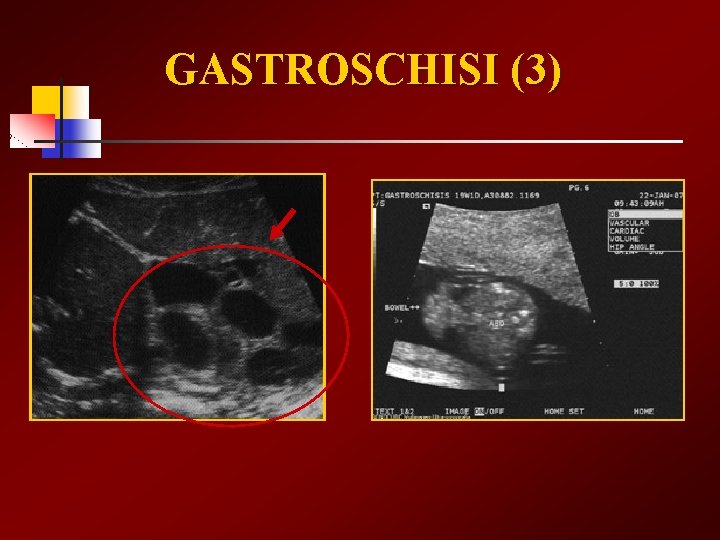 GASTROSCHISI (3) 