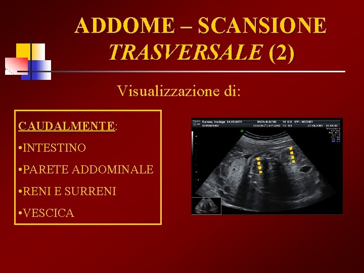 ADDOME – SCANSIONE TRASVERSALE (2) Visualizzazione di: CAUDALMENTE • INTESTINO • PARETE ADDOMINALE •