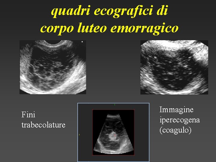 quadri ecografici di corpo luteo emorragico Fini trabecolature Immagine iperecogena (coagulo) 