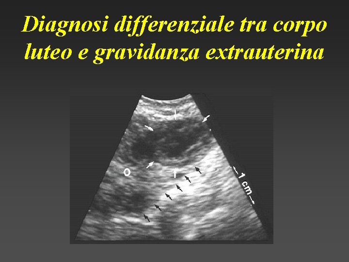 Diagnosi differenziale tra corpo luteo e gravidanza extrauterina 