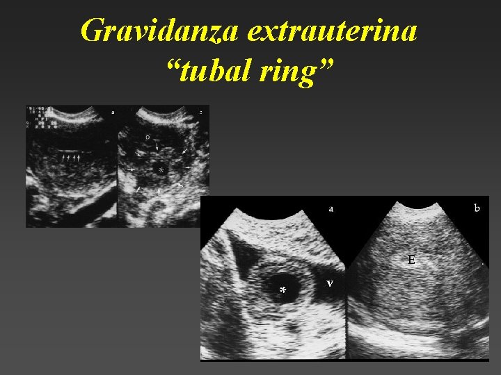 Gravidanza extrauterina “tubal ring” 