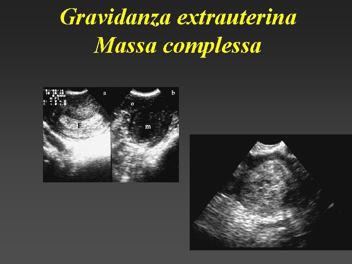 Gravidanza extrauterina Massa complessa 