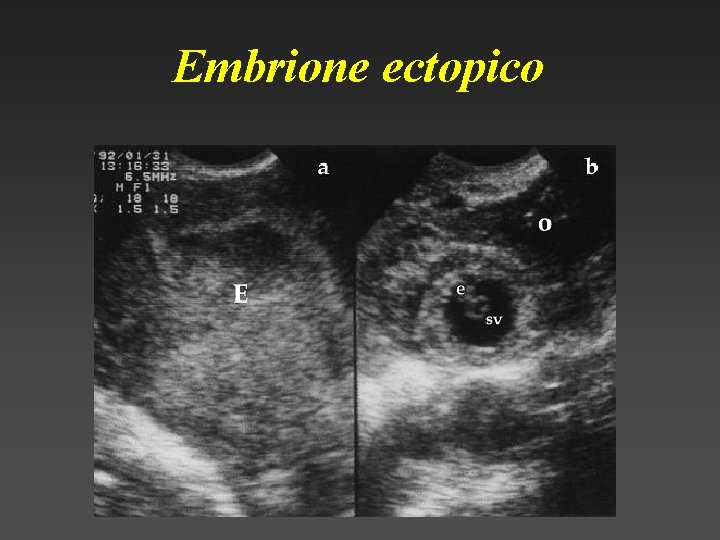 Embrione ectopico 