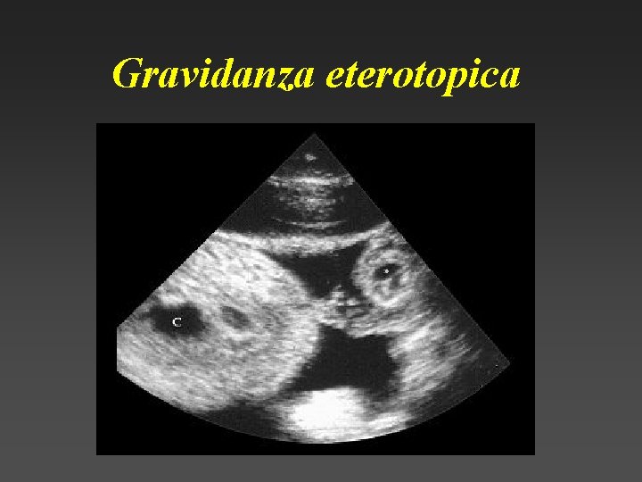 Gravidanza eterotopica 