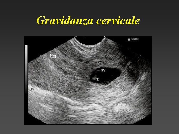 Gravidanza cervicale 