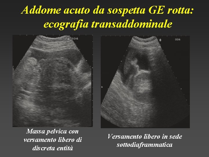 Addome acuto da sospetta GE rotta: ecografia transaddominale Massa pelvica con versamento libero di