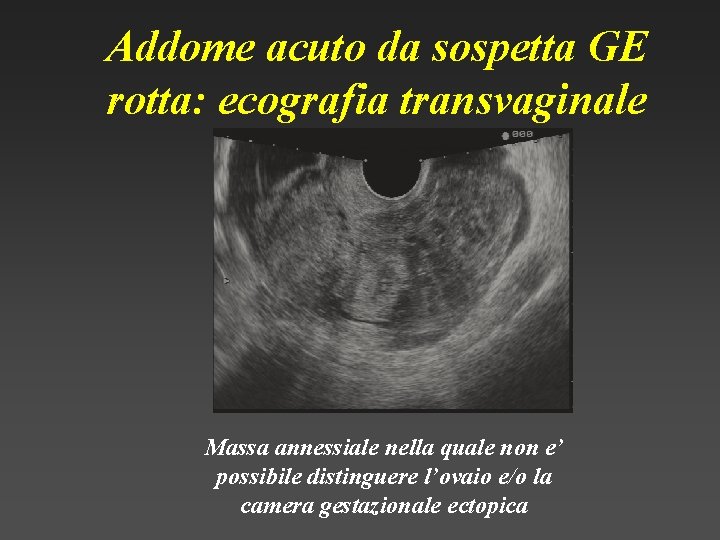 Addome acuto da sospetta GE rotta: ecografia transvaginale Massa annessiale nella quale non e’