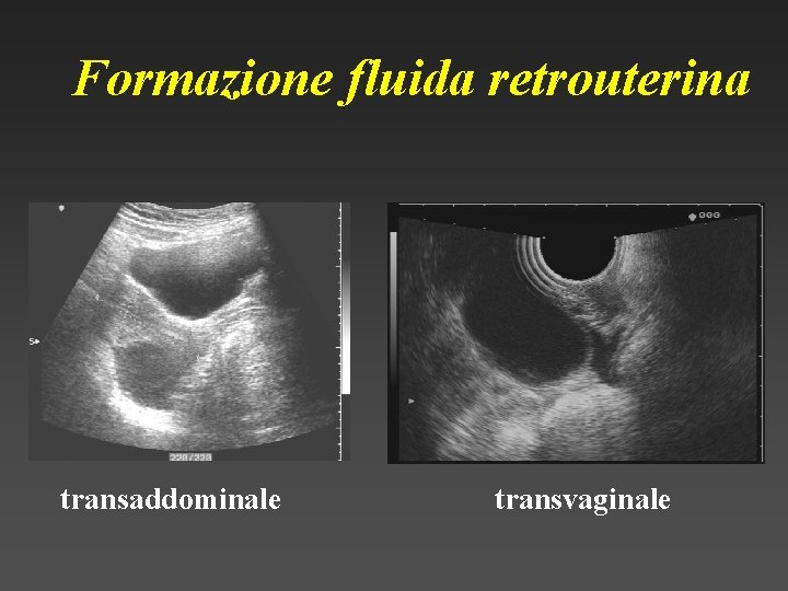 Formazione fluida retrouterina transaddominale transvaginale 