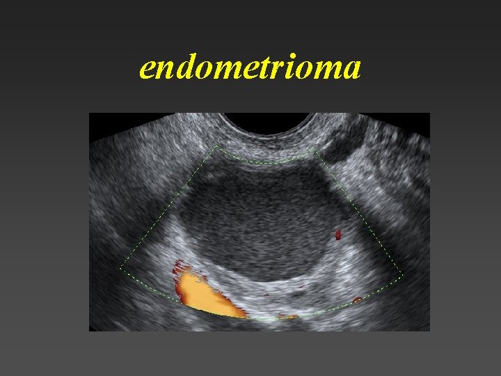 endometrioma 