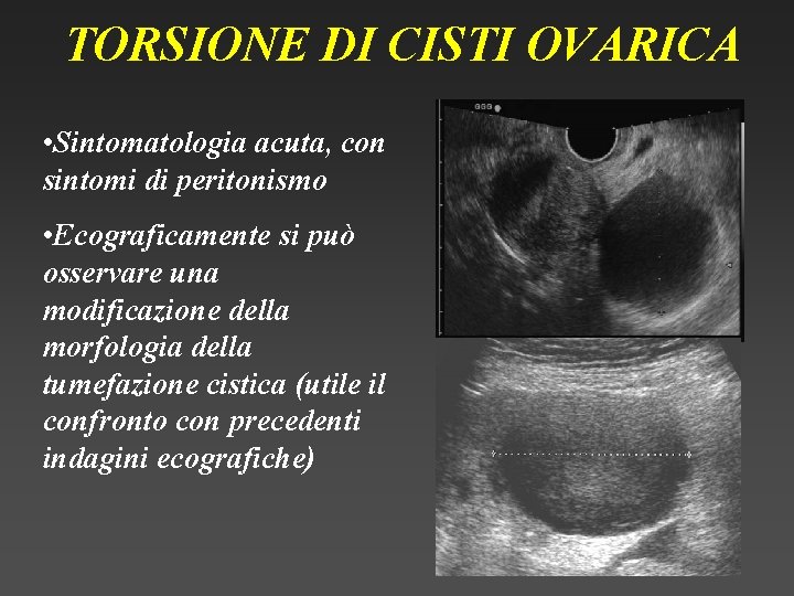 TORSIONE DI CISTI OVARICA • Sintomatologia acuta, con sintomi di peritonismo • Ecograficamente si