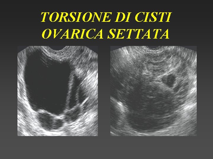 TORSIONE DI CISTI OVARICA SETTATA 