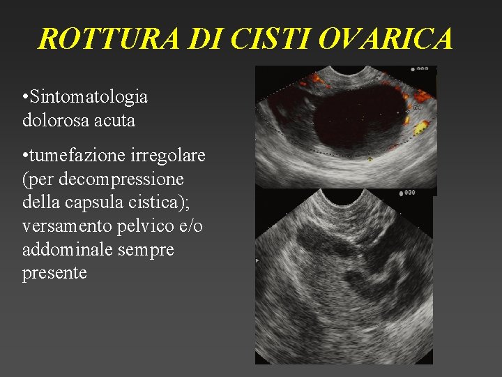 ROTTURA DI CISTI OVARICA • Sintomatologia dolorosa acuta • tumefazione irregolare (per decompressione della