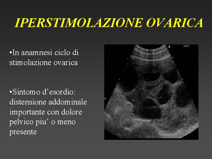 IPERSTIMOLAZIONE OVARICA • In anamnesi ciclo di stimolazione ovarica • Sintomo d’esordio: distensione addominale