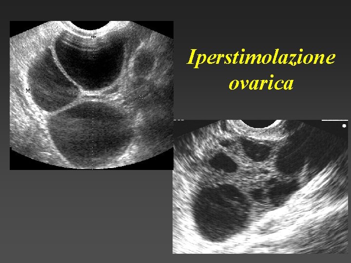 Iperstimolazione ovarica 