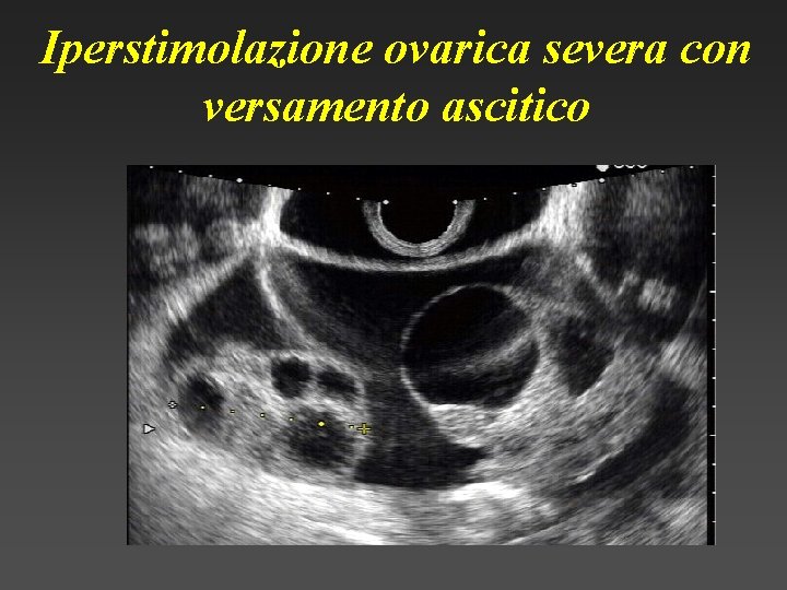 Iperstimolazione ovarica severa con versamento ascitico 