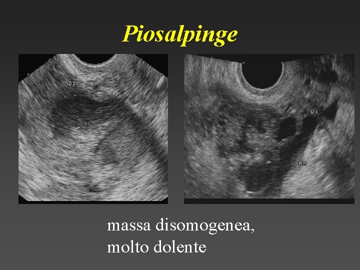 Piosalpinge massa disomogenea, molto dolente 