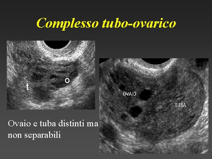 Complesso tubo-ovarico t o Ovaio e tuba distinti ma non separabili 