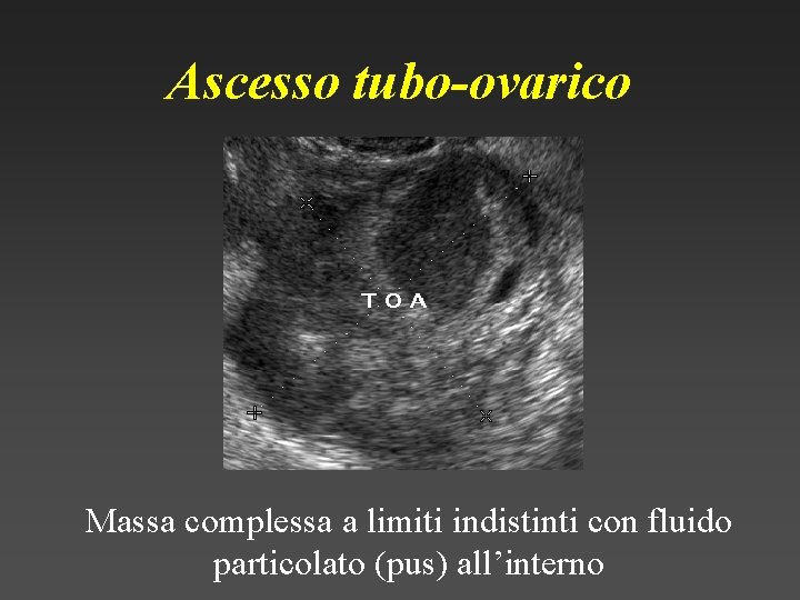Ascesso tubo-ovarico Massa complessa a limiti indistinti con fluido particolato (pus) all’interno 