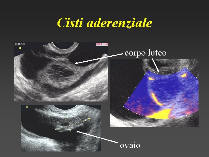 Cisti aderenziale corpo luteo ovaio 