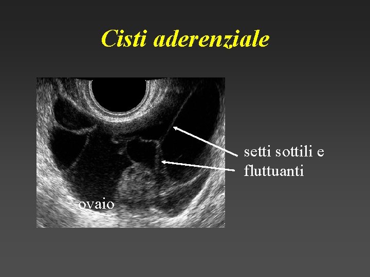 Cisti aderenziale setti sottili e fluttuanti ovaio 