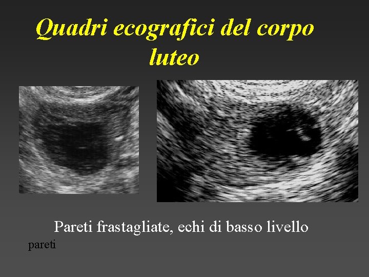 Quadri ecografici del corpo luteo Pareti frastagliate, echi di basso livello pareti 