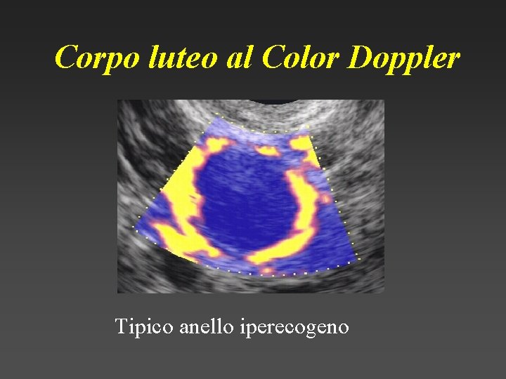 Corpo luteo al Color Doppler Tipico anello iperecogeno 