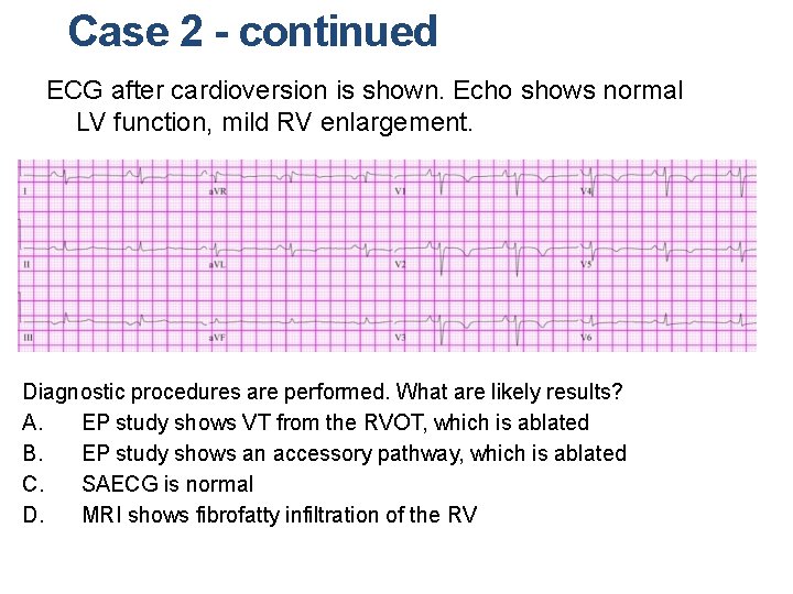 Case 2 - continued ECG after cardioversion is shown. Echo shows normal LV function,
