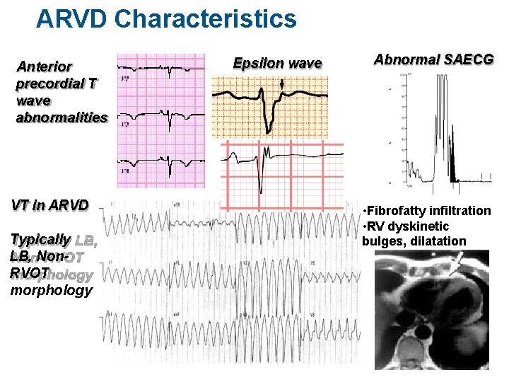 ARVD Characteristics Anterior precordial T wave abnormalities VT in ARVD Typically LB, Non. RVOT