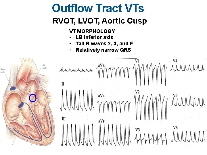 Outflow Tract VTs RVOT, LVOT, Aortic Cusp VT MORPHOLOGY • LB inferior axis •