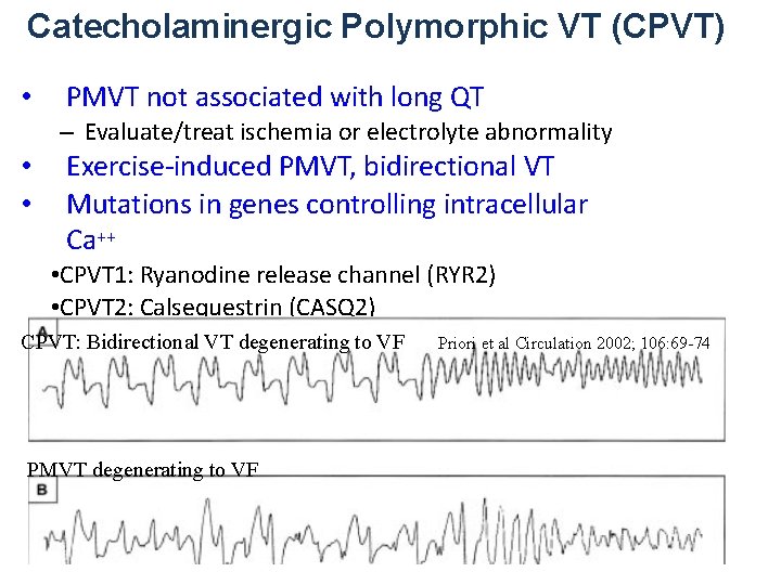 Catecholaminergic Polymorphic VT (CPVT) • PMVT not associated with long QT – Evaluate/treat ischemia