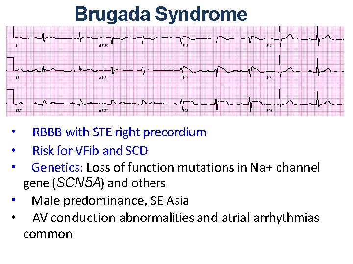 Brugada Syndrome RBBB with STE right precordium Risk for VFib and SCD Genetics: Loss